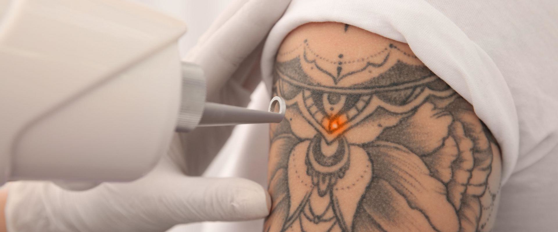 How to Get Rid of Unwanted Tattoos: A Comprehensive Guide to Tattoo Removal